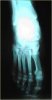 Radiografía del pie el pie en puntas.Vista frontal