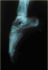 Radiografía e imagen de morfología externa del perfil del pie en posición de (...)