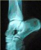Radiografía de un pie en relevé,que cubre la zona del llamado coup de pied o (...)